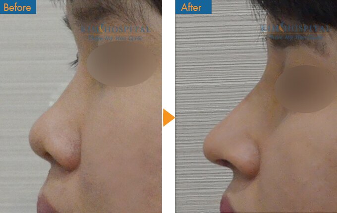 Sau khi phẫu thuật nâng mũi tại Kim Hospital bạn sẽ có được dáng mũi đẹp như ý.