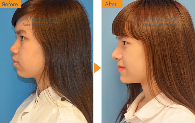 Sau khi nâng mũi S Line (kết hợp độn cằm) tại Kim Hospital: mũi của bạn gái sẽ thon gọn hơn 