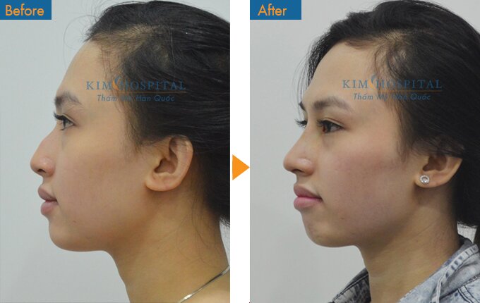 Trước phẫu thuật, chiếc mũi gồ dSau khi nâng mũi S line tại Kim Hospital, khách hàng đã có chiếc mũi mới thon gọn đẹp hơn. 