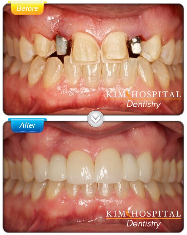 hình ảnh trồng răng implant
